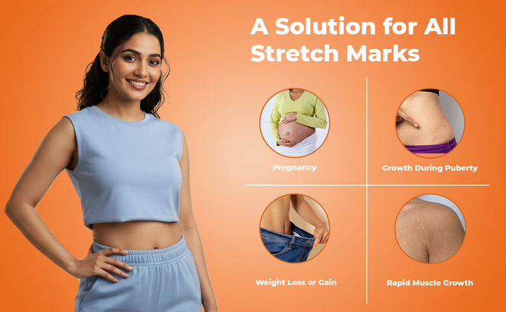 Stretch Marks Are Not Disease. Thats's your skin Asking for Elasticity