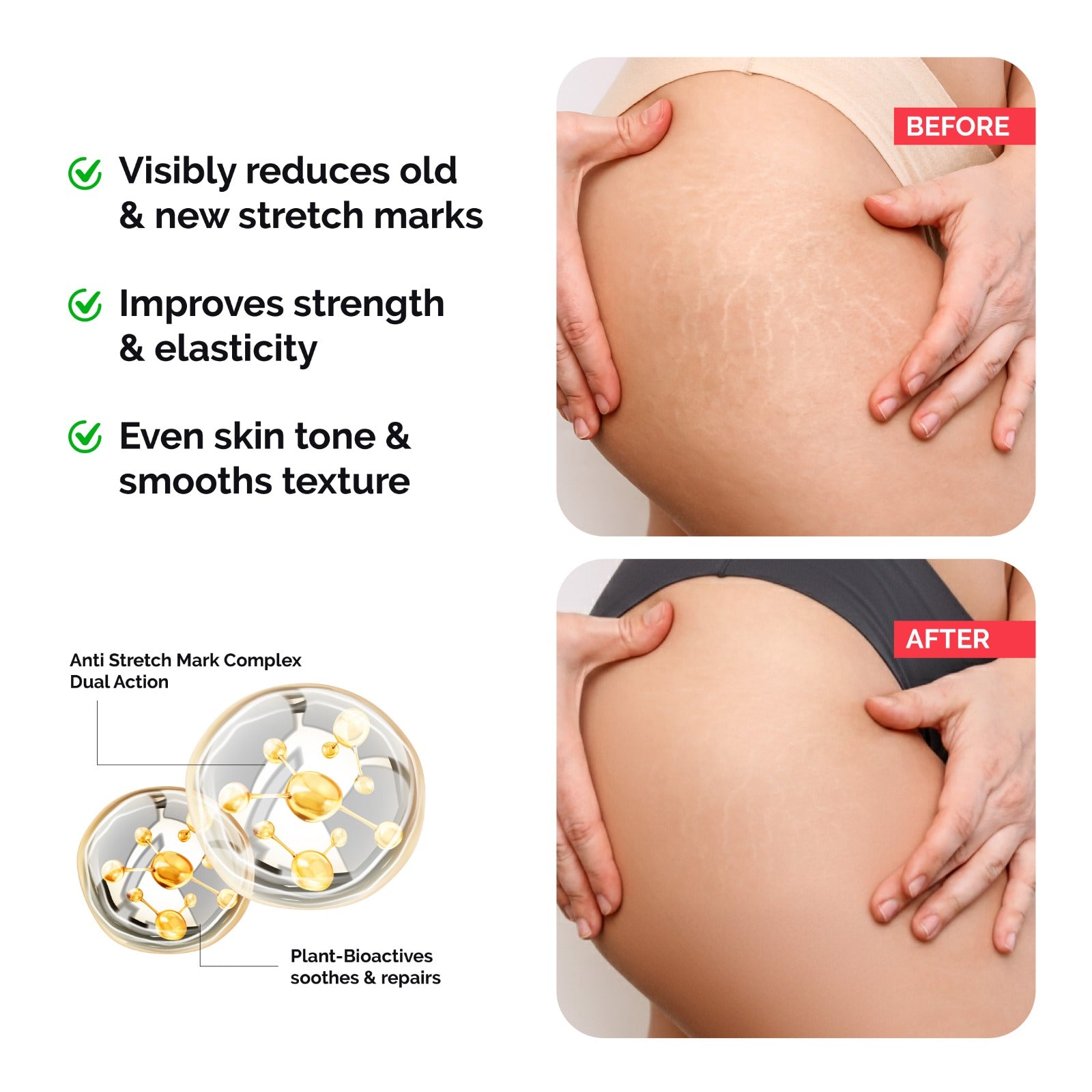 Stretch Marks Cream for Red & White Stretch Marks, Nourishing & Moisturizing Formula (50 gm)